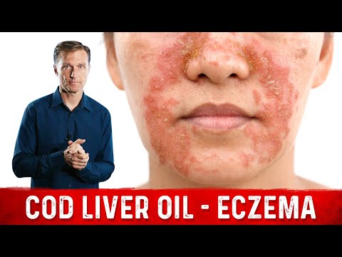 Why Use Cod Liver Oil for Eczema? Remedies for Eczema – Dr. Berg