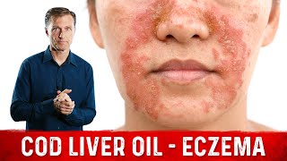Why Use Cod Liver Oil for Eczema? Remedies for Eczema – Dr. Berg
