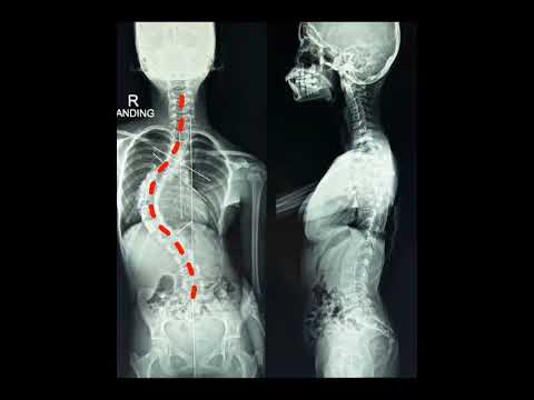 Scoliosis Correction by Dr Tarush Rustagi | Indian spinal injuries centre