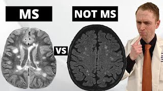 MS MRI Lesions VS. "Benign" White Matter Lesions Explained by Neurologist