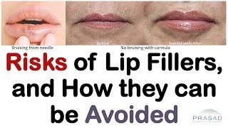 Risks of Lip Filler Treatment, and How Experience can Avoid Them