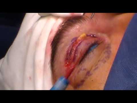 Blefaroplastia superior