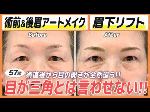 目尻が下がり、視界がボヤける！三角目を丸くして、直後から効果実感！【眉アートメイク＋眉下リフト】