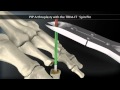 PIP Arthroplasty 360 552WM "pa".mp4 