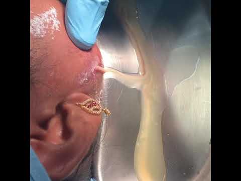 Incision And Drainage Of Saliva From Below The Ear Region - Parotid Sialocele Draining