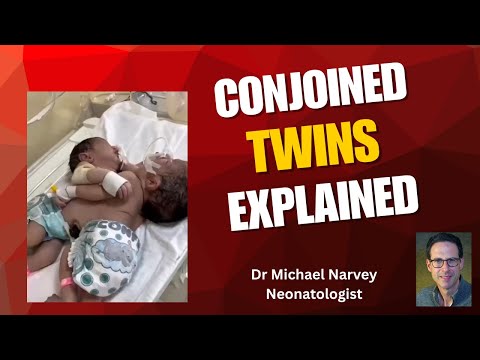 Conjoined #twins    Many varieties but timing is everything! #pediatrics #obstetrics #pregnancy