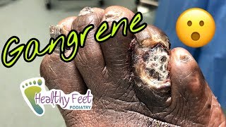 Toe Amputation Due To Gangrene