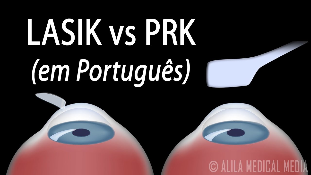 LASIK ou PRK O que é mais adequado para mim Alila Medical Media Português