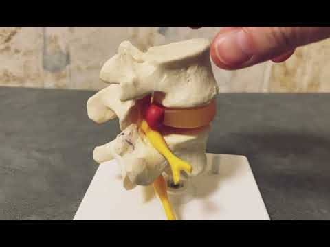 Infiltrazione peridurale senza paura