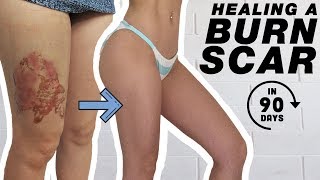 3 Months Burn Update | Healing a Burn Scar