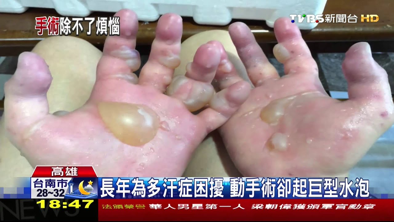 治手汗起巨型水泡 病患控醫師醫療不當