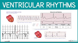Mastering Ventricular Rhythms:Ventricular Tachycardia, Fibrillation & PVCs on ECG