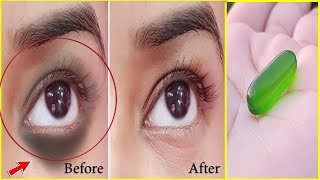 Apply Vaseline on Your Under Eye Dark Circles and See the Magic | Remove Dark Circles in Just 3 Days