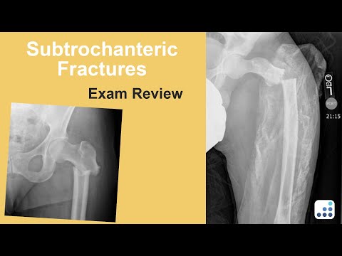 Subtrochanteric Fractures Exam Review - Bohannon Mason, MD