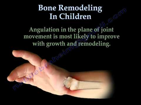 Fractures and Bone Remodeling In Children- Everything You Need To Know - Dr. Nabil Ebraheim
