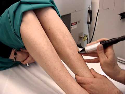 Come coprire una macchia scura su una faccia Bielita decolorazione di crema
