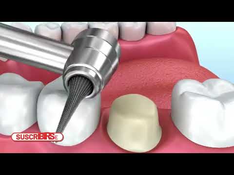 Dental Drills Trailer Biomedical Engineers TV