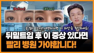 뒤밑트임 재수술, 그냥 풀면 안 되는 이유! 눈 밑이 각지고 울상처럼 보인다면 필독