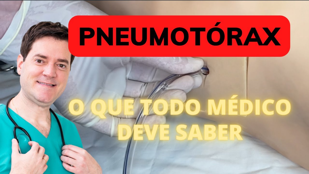 PNEUMOTÓRAX: O QUE TODO MÉDICO DEVE SABER