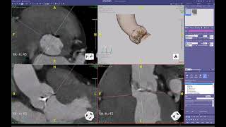 Cusp Overlap view for TAVR.  Manual workflow.  Intuition from Terarecon