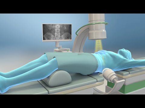 Extracorporeal Shock Wave Lithotripsy (ESWL)