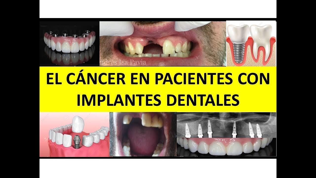 EL CÁNCER EN PACIENTES PORTADORES DE IMPLANTES DENTALES por la Dra. Ana Miranda