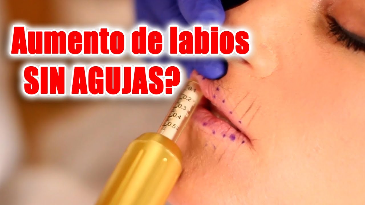 💋 ACIDO HIALURONICO para AUMENTO DE LABIOS SIN AGUJAS 2021💋  HYALURON PEN, La mejor alternativa 🔥