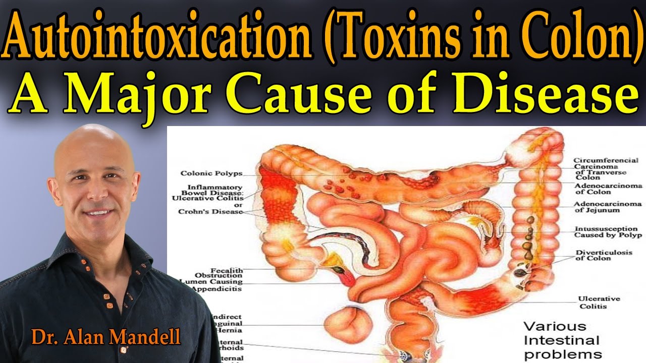 Autointoxication (Toxins in the Colon) - A Major Cause of Pain, Sickness, and Disease - Dr Mandell - YouTube