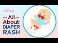 Diaper Rash in Babies –  Symptoms, Causes and Remedies