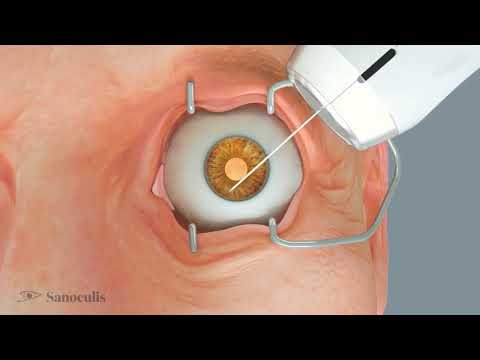 Nir Israeli, Sanoculis - Stent-free glaucoma surgery for better eye flow | LSI USA '26