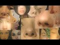 overnight ✦ small alar base n nose tip + removing all nose fat