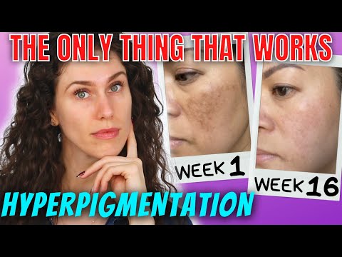 The ONLY Ingredients That Stop Hyperpigmentation (And Reverse It)