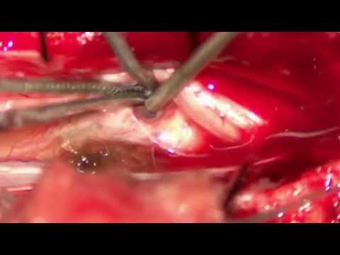 Neuroanesthesia and Neuromonitoring: A Life-Saving Partnership in a Surprising Spinal Case