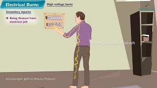 4. Burns (Part-4) : Electrical Burns and Post- Burn Neck Contractures