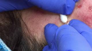 Blackhead Extractions on Leslie