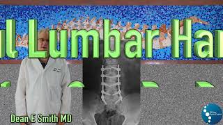 Should I Remove My Lumbar Screws and Rods? Broken Screws.