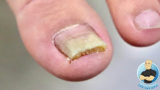 IS THIS TOENAIL FUNGUS? ***LEARN ALL ABOUT NAIL FUNGUS TREATMENT*** MUST WATCH!!!