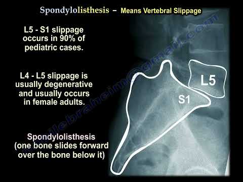 Demystifying Spine Conditions: Understanding Low Back Pain and Related Terms