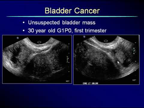 Non Gynecological Findings on Pelvic Scans 4