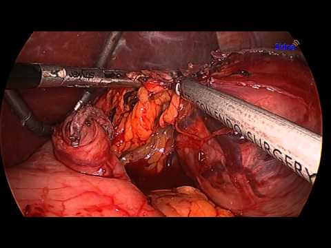 Laparoskopowa gastrektomia z powodu dużego guza żołądka typu GIST 