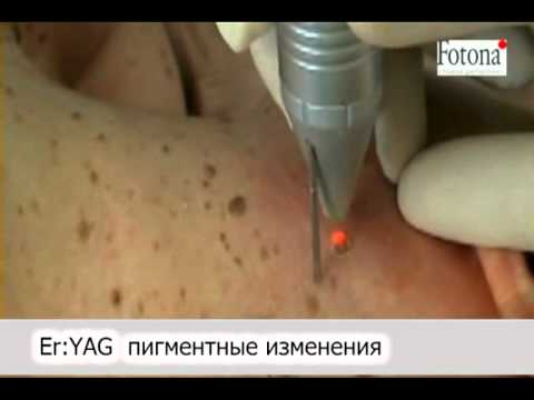Кульбаба от веснушек Витамин е отбеливает веснушки