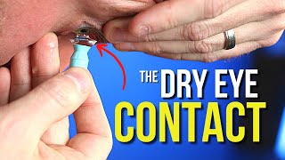 Scleral Lenses: How To Treat Dry Eye With Contacts!