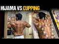 Which Is better And Why ? (HIJAMA VS DRY CUPPING)