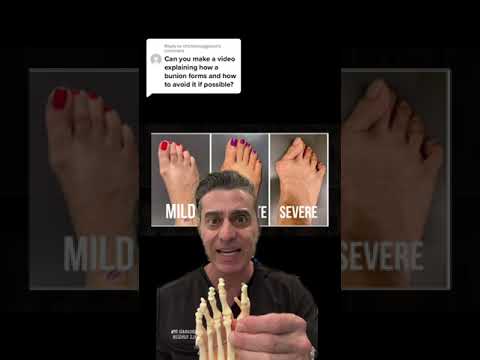 Can You Avoid A Bunion?