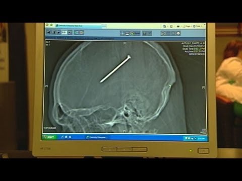 Shocking X-Ray Picture: Man Survives with Nail Lodged in Skull for 36 Hours