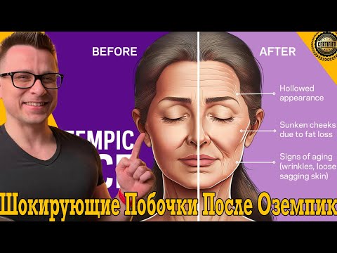 Просто ШОК! Лицо как у ведьмы, а кости как у курицы! Побочки ОЗЕМПИК! Просто ШОК! Лицо как у ведьмы, а кости как у курицы! Побочки ОЗЕМПИК!
