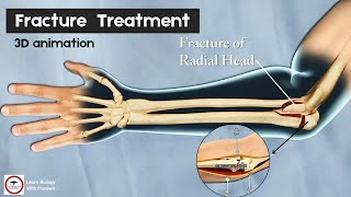 Fracture of the Radial head | 3D animation