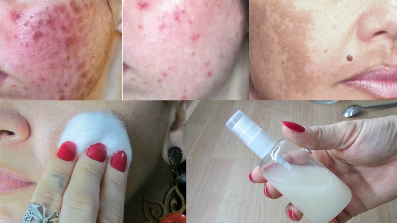 QUANDO SOUBER O QUE USEI PARA APAGAR MANCHAS DO ROSTO VAI QUERER FAZER O MESMO!