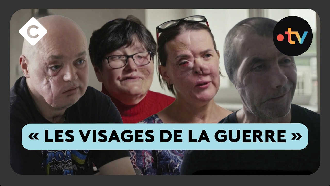 La lente réparation des gueules cassées en Ukraine  - La Story de Louis Amar