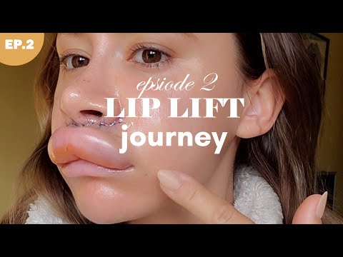 LIP LIFT SURGERY 💉 Episode 2 - When it goes very wrong...